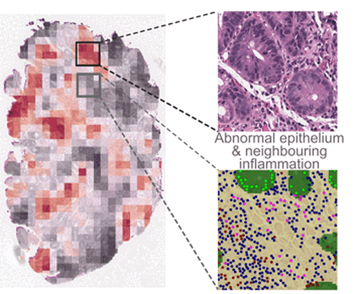 BEACON: spatial map of DNA content abnormality with matched epithelial and immune cell insets
